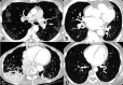 Examples of cases assigned the same RSNA consensus COVID-19 category by all readers.A) “Typical” category assigned to CT of 53-year-old man with COVID-19 pneumonia who presented after 2 weeks of cough, congestion, and fevers. Axial CT image shows multiple ground glass opacities with a peripheral predominance bilaterally, many with a round morphology.B) “Indeterminate” category assigned to CT of 82-year-old woman who presented with fever, exertional dyspnea, palpitations, and chest pain, with 2 PCRs negative for SARS-CoV-2. Axial CT image shows a small amount of ground glass opacity with a central predominance in the perihilar regions bilaterally.C) “Atypical” category assigned to CT of a 79-year-old woman who presented with fever, productive cough, dyspnea, and hypoxemia; 2 PCRs were negative for SARS-CoV-2. Axial CT image shows tree-in-bud nodules and consolidation in the lower lobes bilaterally, a pattern suggesting aspiration/pneumonia.D) “Negative for pneumonia” category assigned to CT of a 30-year-old woman who presented with one week of dry cough, sore throat, and severe fatigue; 2 PCRs were negative for SARS-CoV-2. Axial CT image shows a normal appearance of the lungs. Final diagnosis of symptoms was attributed to recurrent rheumatic myopericarditis within the context of her history of juvenile rheumatoid arthritis.