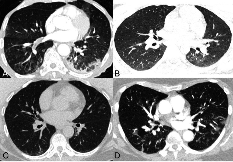 Examples of cases for which there was significant disagreement in assignment of RSNA consensus COVID-19 category.A) 67-year-old man with clinical signs of pneumonia and 4 negative PCRs for COVID-19 with sputum samples positive for streptococcus pneumoniae. Axial CT image shows a combination of tree-in-bud centrilobular nodules in the lower lobes and peripheral ground glass opacity and consolidation in the left lower lobe. Categories 3, 2, and 1 were assigned by 4, 3, and 2 readers respectively.B) year-old man with 2 negative PCR results for SARS-CoV-2 and presumed aspiration or non-23-COVID-19 infection. Axial CT image shows minimal patchy ground glass opacities in the left lower lobe; there was a question of atelectasis or subtle peripheral ground glass opacity in the posterior right lower lobe. Categories 3, 2, 1, and 0 were assigned by 1, 6, 1, and 1 readers respectively.C) 64-year-old woman with PCR-proven COVID-19 pneumonia who presented with fever, productive cough, fatigue, and anosmia. Axial CT image shows patchy ground glass opacities in the lingula and a small amount of peripheral ground glass opacity and atelectasis in the posterior lower lobes. Categories 3, 2, 1, and 0 were assigned by 4, 3, 1, and 1 readers respectively. Reasons given by readers for uncertainty included doubts about peripheral distribution, and difficulty in classification in the setting of minimal disease and posterior atelectasis.D) 65-year-old woman with PCR-proven COVID-19 pneumonia who presented with palpitations, back pain, and low-grade fevers. Axial CT image shows patchy ground glass opacities bilaterally. Categories 3 and 2 were assigned by 5 and 4 readers respectively. Reasons given by readers for uncertainty included difficulty in classifying as peripheral or diffuse and questionable morphology of the ground glass opacities.