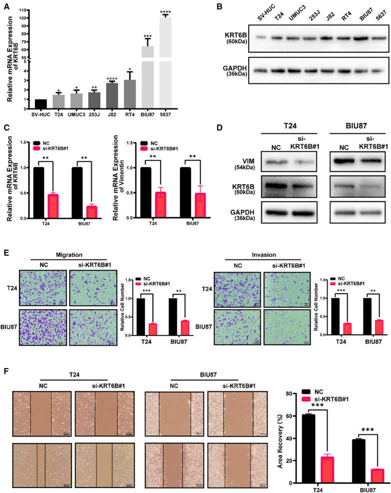 Bladder Cancer-derived Exosomal KRT6B Promotes Invasion And Metastasis ...