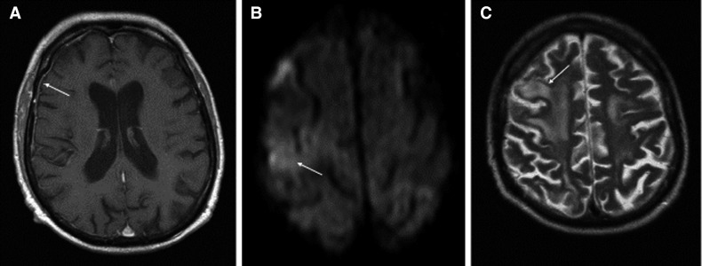 Allograft Infiltration And Meningoencephalitis By Sars Cov 2 In A