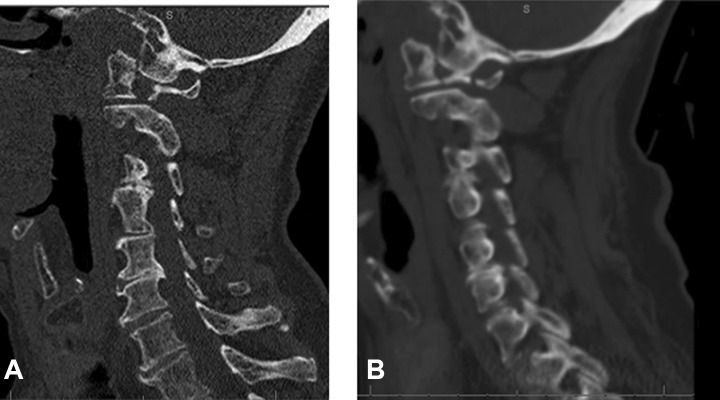 Outcomes of Halo Immobilization for Cervical Spine Fractures - PMC