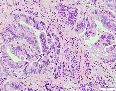 A case of successful conversion surgery for gastric cancer with direct ...