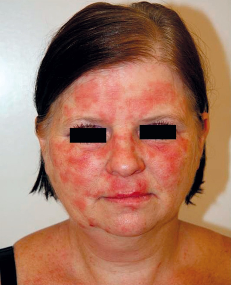 The flare up phenomenon recurrence of distant dermatitis during patch