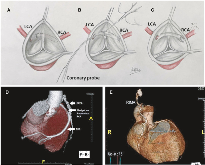 Surgical Techniques for the Treatment of Anomalous Origin of Right ...