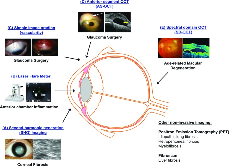 Personalized Medicine in Ocular Fibrosis: Myth or Future Biomarkers - PMC