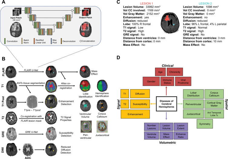 Image shows overview of artificial intelligence (AI) system. A, Schematic of three-dimensional U-Net architecture used for abnormal signal detection. B, Illustration of automatically extracted features by using image processing. All examples except gradient-echo (GRE) susceptibility detection are from patient with primary central nervous system lymphoma. See Materials and Methods section for details on how each feature is extracted. C, Multiple quantitative features are calculated for every lesion in every patient, including those shown in this example. These features are stored, providing rich quantitative description of the lesions. For developing differential diagnosis, thresholded features are then probabilistically combined in Bayesian network. D, Schematic of Bayesian network demonstrates naive Bayesian architecture with complete set of features used by AI system to differentiate diseases of cerebral hemispheres, divided into four categories: clinical, signal, spatial, and volumetric. ADC = apparent diffusion coefficient, ANTs = Advanced Normalization Tools, CC = corpus callosum, DWI = diffusion-weighted imaging, FLAIR = fluid-attenuated inversion recovery, vol = volume.