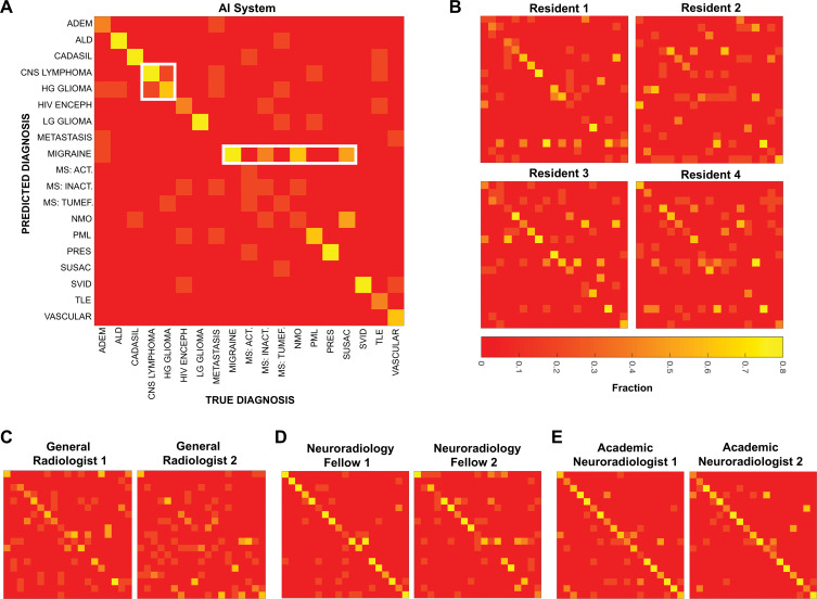 Confusion matrices show sources of diagnostic errors for artificial intelligence (AI) system and individual radiologists for each disease. By convention, true disease labels are shown along x-axis, and predictions are shown along y-axis, with color bar representing fraction of patients of true diagnosis where predicted disease was listed as top diagnosis (ie, columns add up to one). Perfect diagnostic algorithm would result in yellow squares along diagonal from top left to bottom right. At least two types of mistakes are seen both among radiologists and AI system, exemplified by white rectangles for AI system: confusion between similarly appearing diseases, and overdiagnosing certain diseases. Different individuals within a group make different mistakes, and fewer errors occur with increasing specialization. Act = active, ADEM = acute disseminated encephalomyelitis, ALD = adrenoleukodystrophy, CADASIL = cerebral autosomal dominant arteriopathy with subcortical infarcts and leukoencephalopathy, CNS = central nervous system, HG = high-grade, HIV enceph = human immunodeficiency virus encephalopathy, Inact = inactive, LG = low-grade, MS = multiple sclerosis, NMO = neuromyelitis optica, PML = progressive multifocal leukoencephalopathy, PRES = posterior reversible encephalopathy syndrome, SVID = small vessel ischemic disease, TLE = toxic leukoencephalopathy, tumef = tumefactive.