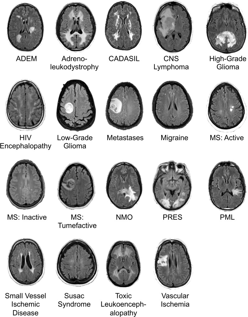 Image shows example axial fluid-attenuated inversion recovery (FLAIR) slice for each of 19 neurologic diseases included in study. ADEM = acute disseminated encephalomyelitis, CADASIL = cerebral autosomal dominant arteriopathy with subcortical infarcts and leukoencephalopathy, CNS = primary central nervous system, HIV = human immunodeficiency virus, MS = multiple sclerosis, NMO = neuromyelitis optica, PML = progressive multifocal leukoencephalopathy, PRES = posterior reversible encephalopathy syndrome. Range of repetition time and echo time values are given in Table 2.