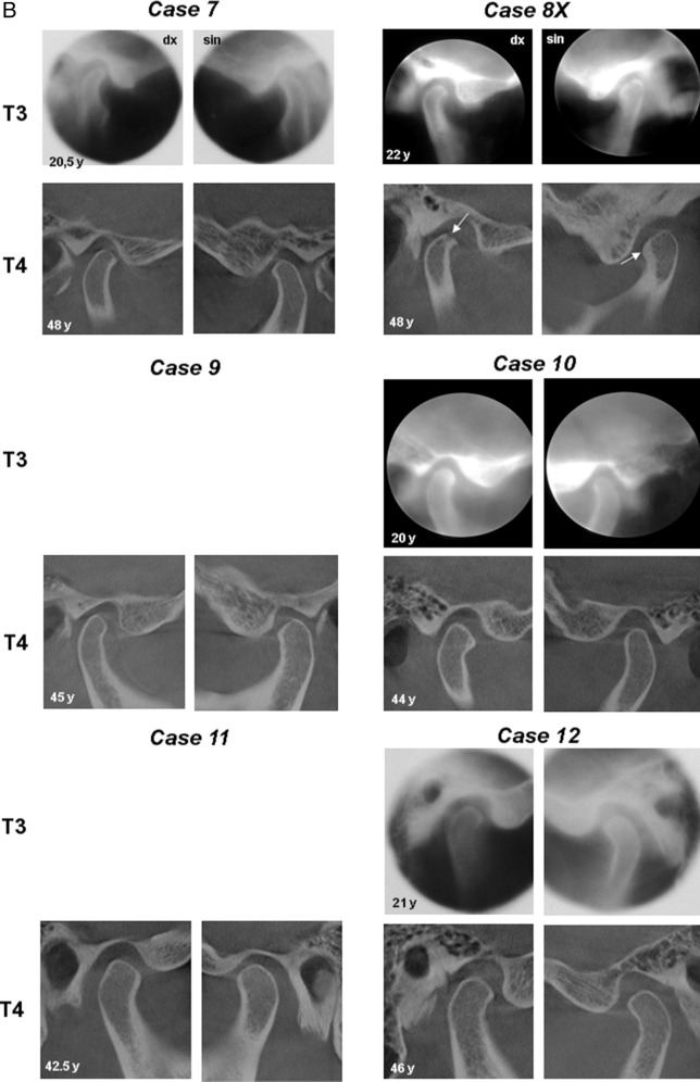 Figure 1. Continued. (arrows). (C) TMJ radiographs (right and left side) from 14 Class II division 1 malocclusions (Cases 13 and 14) treated with the Herbst appliance. Conventional lateral tomograms from T3 (6 years after treatment) and CBCT examinations from T4 (32 years after treatment). Note osteoarthritic changes in Case 14 at T4 (arrow). The T3 lateral tomograms are from the publication of Hansen et al.6 with kind permission of the European Journal of Orthodontics.