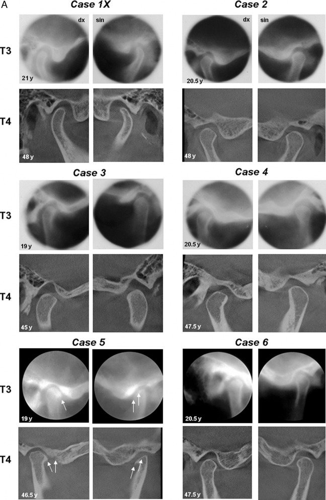 Figure 1. (A) TMJ radiographs (right and left side) from 14 Class II division 1 malocclusions (Cases 1–6) treated with the Herbst appliance. Conventional lateral tomograms from T3 (6 years after treatment) and CBCT examinations from T4 (32 years after treatment). Note the osteoarthritic changes in Case 5 at T3 and T4 (arrows). (B) TMJ radiographs (right and left side) from 14 Class II division 1 malocclusions (Cases 7–12) treated with the Herbst appliance. Conventional lateral tomograms from T3 (6 years after treatment) and CBCT examinations from T4 (32 years after treatment). In the Cases 9 and 11 (females) no lateral tomograms existed from T3. Note osteoarthritic changes in Case 8X at T4.