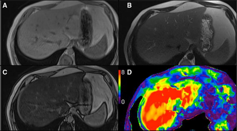 Evaluation of Hepatic Fibrosis: A Review from the Society of Abdominal ...