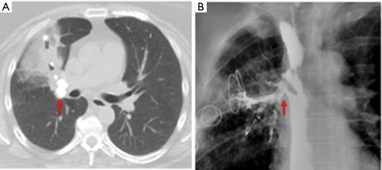 Management of broncholithiasis - PMC