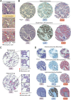 Figure 1. Identification of tumor cells by AI-powered digital pathology on H&E slides of NSCLC. A, Overview of the image-processing pipeline used to recognize NSCLC tumor cells. 1. H&E: Digitized slide images were prepared from H&E-stained tissues and imported in the QuPath software; the image patch represents H&E. 2. Cell detection: Nuclear segmentation performed via the StarDist tool; the image patch represents an overlay of the segmented nuclei onto the H&E. 3. Cell classification: Single cells classified as either tumor or nontumor cells by a machine learning–based tool; the image patch represents an overlay of the classified cells onto the H&E. B, Representative H&E and IHC staining of a TTF-1–positive adenocarcinoma (top), a p40-positive squamous cell carcinoma (bottom), and identification of tumor cells by the AI tool (left patches). H&E and IHC of the biopsy cores were performed on two consecutive TMA sections. C, Validation of the AI approach (Train Object Classifier tool, embedded in the QuPath software) in normal regions. Both in normal lung tissue (top) and adjacent lung tissue (bottom), the AI tool does not recognize tumor cells. D, The AI tool recognizes tumor cells across NSCLC histologic subtypes. Representative H&E and IHC staining of TTF-1–positive adenocarcinoma subtypes (mucinous, micropapillary, papillary), and a p40-positive squamous-basaloid cell carcinoma subtype and identification of tumor cells by the AI tool (left patches). Scale bars, 100 μm (B–D), 20 μm (A and insets).