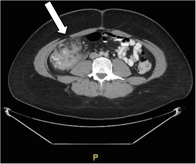 Operative versus non-operative therapy for acute phlegmon of the ...