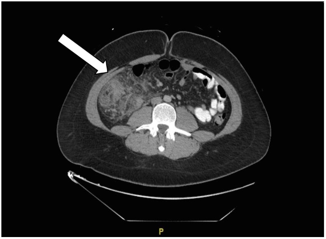 Operative versus non-operative therapy for acute phlegmon of the ...