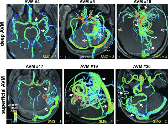 Intracranial 4D Flow MRI: Toward Individualized Assessment of ...