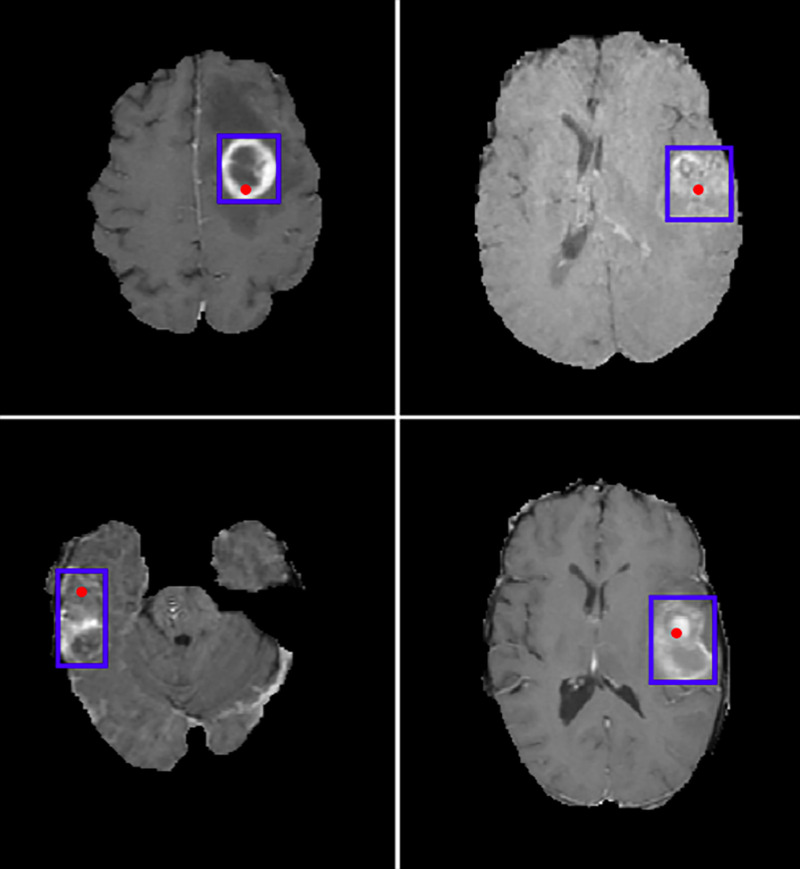 Example test-set images from the Brain Tumor Segmentation database with convolutional neural network–predicted lesion location in red and bounding box of the hand-annotated mask (ground truth) in blue.