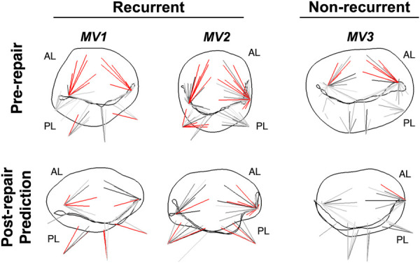 MVCT axial S11 stress in the three patient MVs before and after repair. The MVs are shown in the ventricular view, with MVCT axial stress above 3 MPa highlighted in red and MVCT with stress less than 0.5 MPa not plotted. All three MVs demonstrate high MVCT stress in the anterior leaflet pre-repair. After repair, this stress is offloaded in the nonrecurrent MV, but in both recurrent MVs, this stress is transferred to the posterior leaflet, likely due to exacerbated posterior leaflet tethering imposed by the ring. AL: anterior leaflet; PL: posterior leaflet.