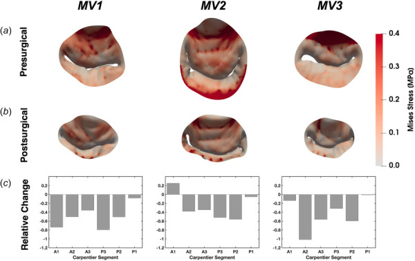 The MV leaflet von Mises stress for the three patient MVs (MV1: recurrent; MV2: recurrent; MV3: nonrecurrent). (a) The presurgical von Mises stress distributions. (b) The postsurgical von Mises stress distributions. (c) The relative change in von Mises stress between the pre- and postsurgical states by Carpentier segment for the three patient MVs.