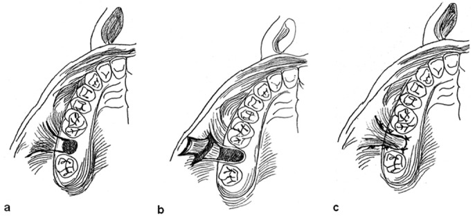 Oro-Antral Fistula Repair With Different Surgical Methods: a ...