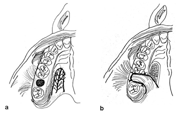 Oro-Antral Fistula Repair With Different Surgical Methods: a ...