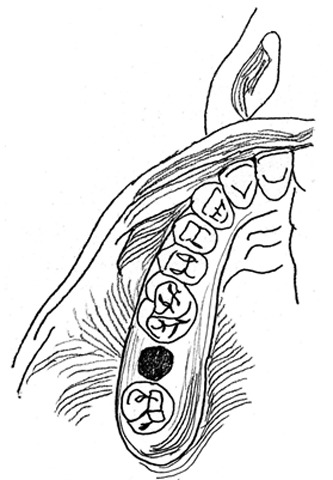 Oro-Antral Fistula Repair With Different Surgical Methods: a ...