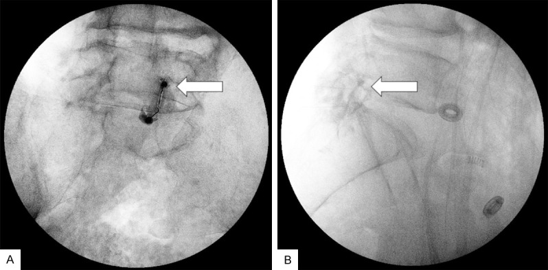 Successful treatment of facet joint synovial cyst through percutaneous ...