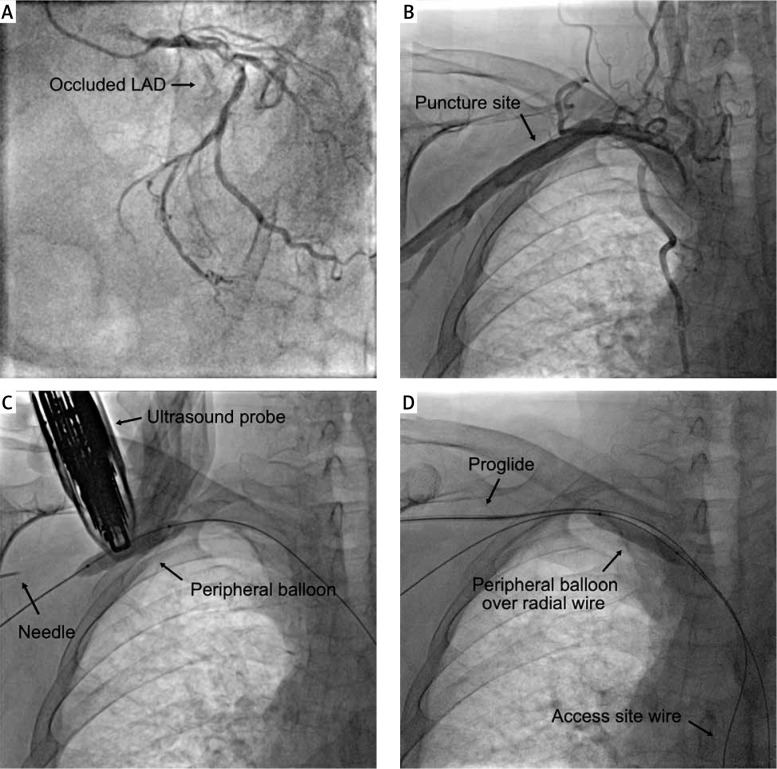 Fully percutaneous insertion and removal of the Impella CP via a ...