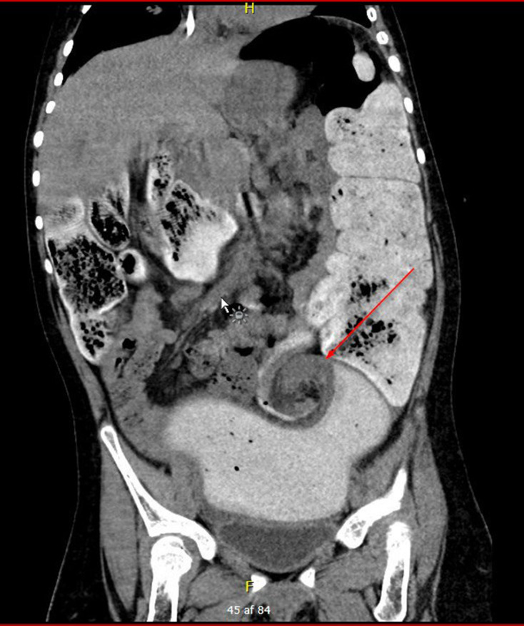 Sigmoid Volvulus In Children - Pmc