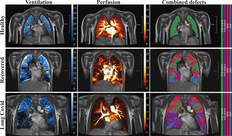 Free-breathing phase-resolved functional lung, or PREFUL, low-field-strength MRI at 0.55 T with calculated parameters at the axial plane after automatic registration to a midexpiration position and lung parenchyma segmentation. From left to right, representative color-coded images from functional lung MRI show ventilation defects (blue), perfusion defects (red), ventilation-perfusion (V/Q) match (green), and V/Q defects (purple) in a healthy control participant (upper row, 7-year-old boy), a participant who recovered from COVID-19 (middle row, 10-year-old boy), and a participant with long COVID (bottom row, 15-year-old boy). QDP = perfusion defect percentage, VDP = ventilation defect percentage.