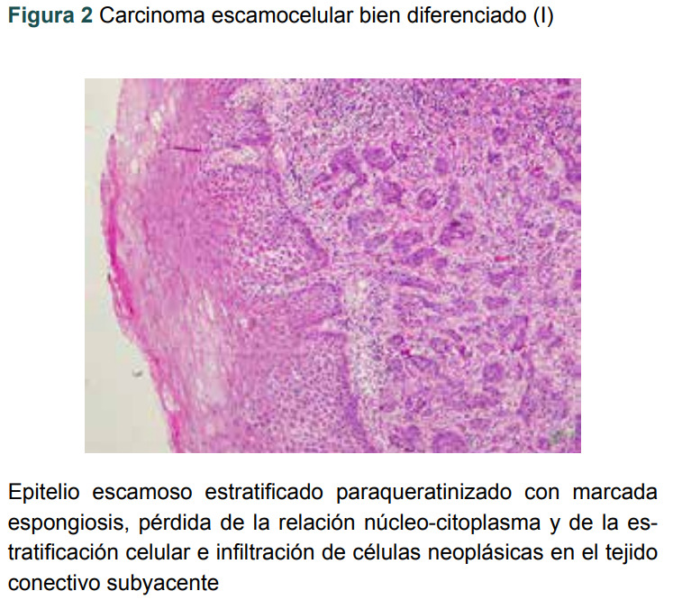 Figura 2 Carcinoma escamocelular bien diferenciado (I)