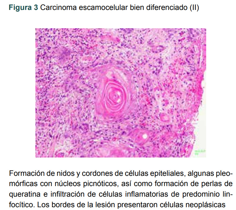 Figura 3 Carcinoma escamocelular bien diferenciado (II)