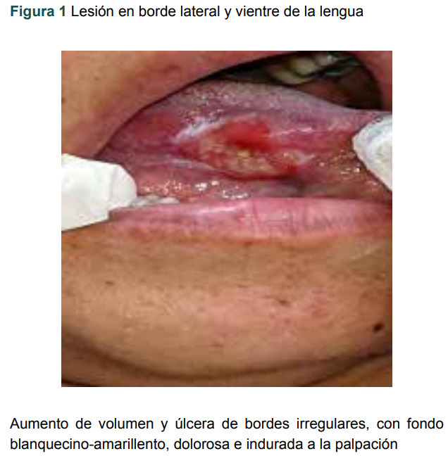 Figura 1 Lesión en borde lateral y vientre de la lengua