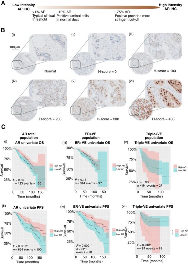 Figure 1. Survival analysis of a TMA of primary breast cancer stained immunohistochemically for AR (n = 844). A, Graphical representation of common cut-off points in AR IHC studies with the bulk of clinical data applying an AR protein expression >1% to denote a positive stain. Normal breast ducts are reported to express approximately 12%. A more stringent cut-off point of 75% has been reported, and this was applied to the current study. B, AR protein expression was recorded as H-score (0–400) with a cut-off point of H-score = 300. Representative TMA cores of AR staining in normal breast tissue are depicted (i), alongside images of tumor staining of AR ranging in intensity from 0 to 400 (ii–vi). C, (i), Kaplan–Meier of OS univariate analysis of AR in the total population, log rank P = 0.07. (ii), Kaplan–Meier of PFS of the same population, log rank P = 0.001. (iii), Kaplan–Meier of OS univariate analysis of AR in the ER population, log rank P = 0.18. (iv), Kaplan–Meier of PFS of the same population, log rank P = 0.002. (v), Kaplan–Meier of OS univariate analysis of AR in the triple negative population, log rank P = 0.33. (vi), Kaplan–Meier of PFS of the same population, log rank P = 0.013.