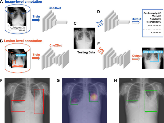 Training-testing flows of CheXNet and CheXDet. (A) CheXNet is trained with radiograph-level annotations that indicate whether specific diseases exist on the whole radiograph. (B) CheXDet is trained with lesion-level annotations that further point out the exact locations of lesions with bounding boxes. (C) A testing chest radiograph. (D) CheXNet predicts the probabilities of each abnormality. (E) CheXDet could identify the lesion regions with corresponding disease scores. (F) Another testing image with pleural effusion lesions bounded in the red boxes. (G) The localization results were given by CheXNet using the class activation map method, which is widely adopted by researchers to interpret the results of a deep classification model. Lighter color indicates a higher probability of abnormality found by CheXNet. The top 40% pixels on the heatmaps are bounded by the green boxes as the final localization results. (H) The localization results given by CheXDet are indicated with green boxes.