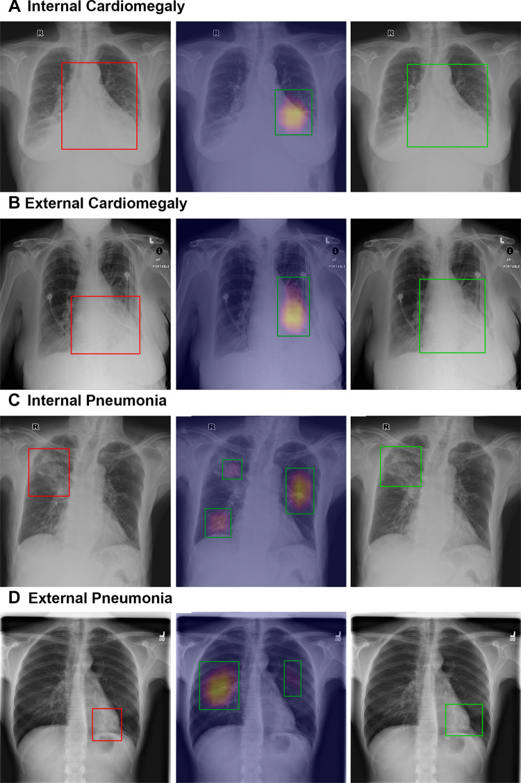 Sample localization results of CheXNet and CheXDet. Qualitative samples of lesion localization results for (A, B) cardiomegaly and (C, D) pneumonia on the (A, C) internal dataset (dataset 1) and (B, D) external set (National Institutes of Health ChestX-ray14). Ground truth with bounding boxes (red, left column), gradient-weighted class activation map generated by CheXNet (middle column), and localization of output of ChexDet (right column) are demonstrated. For gradient-weighted class activation maps, the color overlay indicates a higher probability of abnormality found by CheXNet, and the top 40% pixels on the heatmaps are bounded by the green boxes as the final localization results. CheXDet outputs the correct bounding box for cardiomegaly, outlining the entirety of the heart (same as ground truth labeling), while CheXNet only focuses on the left side of the heart. This was evident on both the internal and external datasets. CheXDet localizes the correct locations for pneumonia changes; CheXNet included nontargeted areas in C, likely due to fibrotic changes, and missed the targeted area entirely in D, instead identifying false-positive areas, which appear normal radiographically.