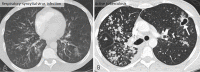 Atypical CT imaging features for COVID-19. Axial CT images from two different patients showing tree-in-bud opacities and centrilobular nodules, caused by respiratory syncytial virus (A) and active tuberculosis (B). A small cavity (arrow) is also present in (B) Routine screening CT for diagnosis or exclusion of COVID-19 is currently not recommended by most professional organizations or the U.S. Centers for Disease Control and Prevention.