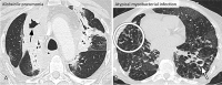 Atypical CT imaging features for COVID-19. Axial images of the lungs of two patients showing cavitation (arrow) in Klebsiella pneumonia (A) and tree-and-bud opacities (circle) and a cavity (arrow) in nontuberculous mycobacterial infection (B). Routine screening CT for diagnosis or exclusion of COVID-19 is currently not recommended by most professional organizations or the U.S. Centers for Disease Control and Prevention.