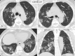 Typical CT imaging features for COVID-19. Unenhanced thin-section axial (A–C) and coronal multiplanar reformatted images (D) of the lungs in a 77-year-old man with a positive RT-PCR show bilateral, multifocal rounded and peripheral GGO. Routine screening CT for diagnosis or exclusion of COVID-19 is currently not recommended by most professional organizations or the U.S. Centers for Disease Control and Prevention.