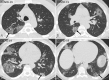 Typical CT imaging features for COVID-19. Unenhanced thin-section axial images of the lungs in a 52-year-old man with a positive RT-PCR (A–D) show bilateral, multifocal rounded (asterisks) and peripheral GGO (arrows) with superimposed interlobular septal thickening and visible intralobular lines (“crazy-paving”). Routine screening CT for diagnosis or exclusion of COVID-19 is currently not recommended by most professional organizations or the U.S. Centers for Disease Control and Prevention.