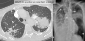 Atypical CT imaging features for COVID-19. Contrast-enhanced axial CT image (A) and frontal chest radiograph (B) showing segmental consolidation without significant GGO. Although this patient tested positive for COVID-19, the imaging features are not typical and could represent pneumonia related to COVID-19 or a secondary infectious process. Routine screening CT for diagnosis or exclusion of COVID-19 is currently not recommended by most professional organizations or the U.S. Centers for Disease Control and Prevention.