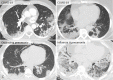 Typical CT imaging features for COVID-19 and other diseases with similar findings. Posterior, peripheral, and rounded GGO and consolidation in axial images of four patients; COVID-19 (A, B), organizing pneumonia secondary to dermatomyositis (C), and influenza A pneumonia (D). Organizing pneumonia and influenza pneumonia can be indistinguishable from COVID-19 by CT. Routine screening CT for diagnosis or exclusion of COVID-19 is currently not recommended by most professional organizations or the U.S. Centers for Disease Control and Prevention.