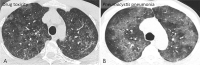 Indeterminate CT imaging features for COVID-19. Widespread GGO with nonrounded morphology and no specific distribution in unenhanced axial images from two different patients secondary to acute lung injury from presumed drug toxicity (A) and Pneumocystis pneumonia (B). Routine screening CT for diagnosis or exclusion of COVID-19 is currently not recommended by most professional organizations or the U.S. Centers for Disease Control and Prevention.