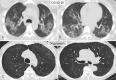 Indeterminate CT imaging features for COVID-19. Unenhanced axial images in two patients showing patchy GGO with nonrounded morphology and no specific distribution, in a case of COVID-19 pneumonia (A, B) and acute lung injury from presumed drug toxicity (C, D). Routine screening CT for diagnosis or exclusion of COVID-19 is currently not recommended by most professional organizations or the U.S. Centers for Disease Control and Prevention.
