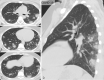 Typical CT imaging features for COVID-19. Unenhanced axial (A–C) and sagittal multiplanar reformatted (D) images of the lungs in a 29-year-old man with a positive RT-PCR show multiple bilateral, rounded consolidations with surrounding GGO. Routine screening CT for diagnosis or exclusion of COVID-19 is currently not recommended by most professional organizations or the U.S. Centers for Disease Control and Prevention.