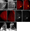 Images obtained in a 69-year-old female patient with a new
biopsy-proven malignant lesion in the left breast. (A, B) The malignant
lesion corresponds with a 2.5-cm irregular and spiculated mass (arrow) and
an additional oval and circumscribed mass (double arrows) on left
mediolateral oblique and craniocaudal spot compression mammographic views.
US-guided core-needle biopsy revealed grade 3 invasive ductal carcinoma
(arrow) and fibroadenoma (double arrow). Left positron emission mammographic
(PEM) (C) craniocaudal and (D) mediolateral oblique color images obtained 1
hour after intravenous injection of 74 MBq of fluorine 18–labeled
fluorodeoxyglucose (18F-FDG) show a mass (known cancer) with intense uptake
and no uptake in the biopsy-proven fibroadenoma. Right PEM (E) craniocaudal
and (F) mediolateral oblique color images obtained 1 hour after intravenous
injection of 74 MBq of 18F-FDG do not show any abnormal uptake. Left PEM
craniocaudal images obtained (G) 1 hour and (H) 4 hours after intravenous
injection of 74 MBq of 18F-FDG show no substantial visual difference in
uptake of known cancer. (I) Axial contrast-enhanced fat-saturated subtracted
T1-weighted MR image with maximum intensity projection reconstruction
obtained 90 seconds after intravenous injection of 0.1 mmol of
gadolinium-based contrast material per kilogram of body weight also shows
the left-sided enhancing mass (arrow) corresponding to known malignancy and
the biopsy-proven fibroadenoma (double arrows), as well as multiple
nonspecific foci of enhancement in the contralateral breast, with one being
the most conspicuous (arrow). The patient underwent bilateral lumpectomy.
The final pathologic results in the left breast confirmed grade 3 invasive
ductal carcinoma and yielded atypical ductal hyperplasia in the right
breast.