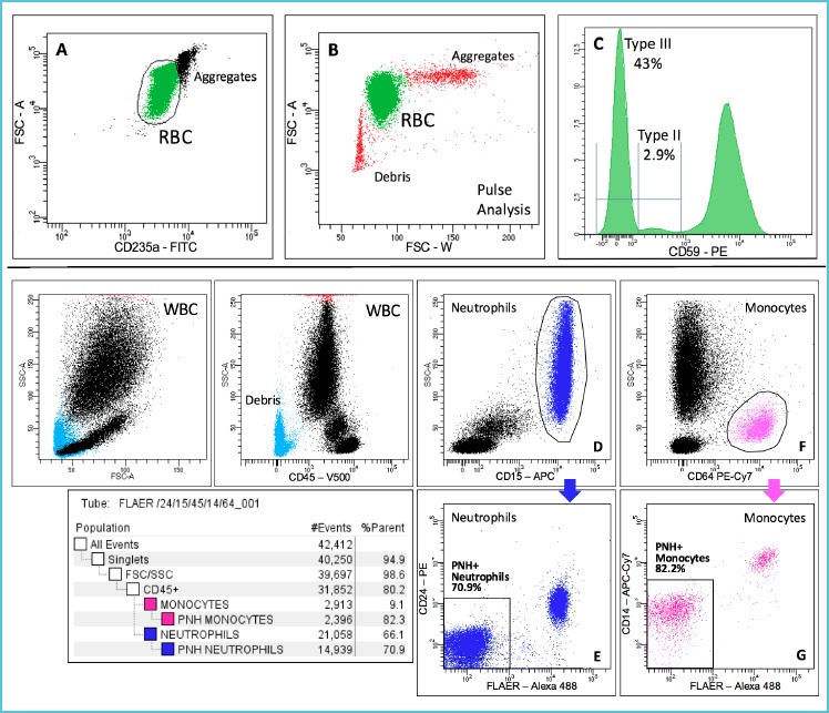 Upper panels: RBC analysis using CD235a for gating (A) and CD59 for PNH clone detection. Type II and Type III clones are detectable (C). In panel (B) the FSC pulse analysis of RBC shows a good discrimination of RBC singlets from debris and aggregates. Lower panels: WBC analysis using CD15 as the gating marker for neutrophils (D) and CD64 as the gating marker for monocytes (F). Panel (E) shows a large PNH neutrophil clone, identified by combining FLAER and CD24. Panel (G) shows a large monocyte clone, identified by FLAER and CD14.