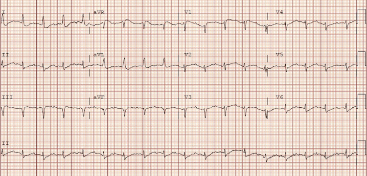 Hypokalemia Induced Cardiac Arrest PMC hypokalemia-induced-cardiac-arrest-pmc