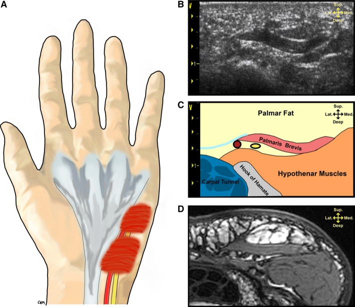 Structural and functional anatomy of the palmaris brevis: grasping for ...