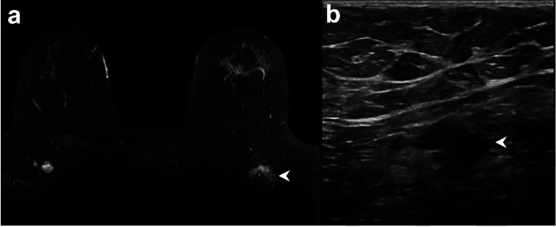 Example of vaccine-associated adenopathy in a 41-year-old female patient undergoing breast MRI for follow up of focal lesion. (a) T2-weighted fat-saturated axial slice through the breasts and anterior chest, within 5 days of receiving COVID-19 vaccination in the left shoulder showing asymmetric left axillary adenopathy (3.0 x 1.7 cm, arrowhead) with preserved fatty hilum but irregular cortex. (b) 6-week follow-up axillary sonography of the same patient demonstrates decreased size (2.2 x 1.1 cm) and some residual cortical thickening.